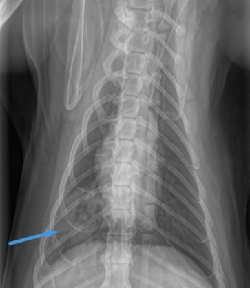 Lung-rad-focal-infiltrate-RCLL