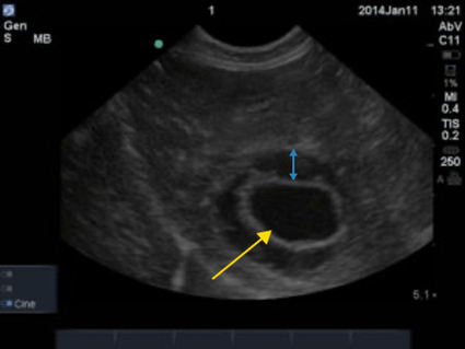 Ultrasound Findings in Anaphylaxis Blog Post Image 1