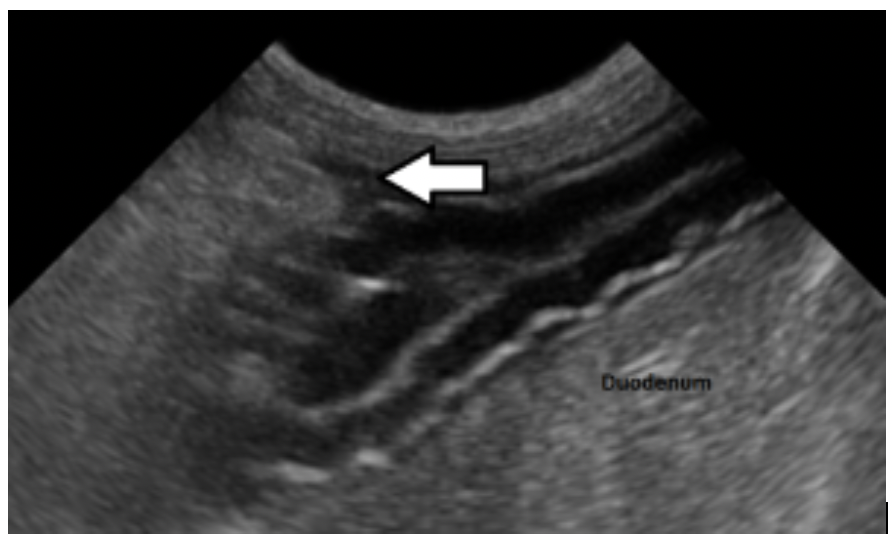 Case Study: Ultrasound Findings in Peritonitis